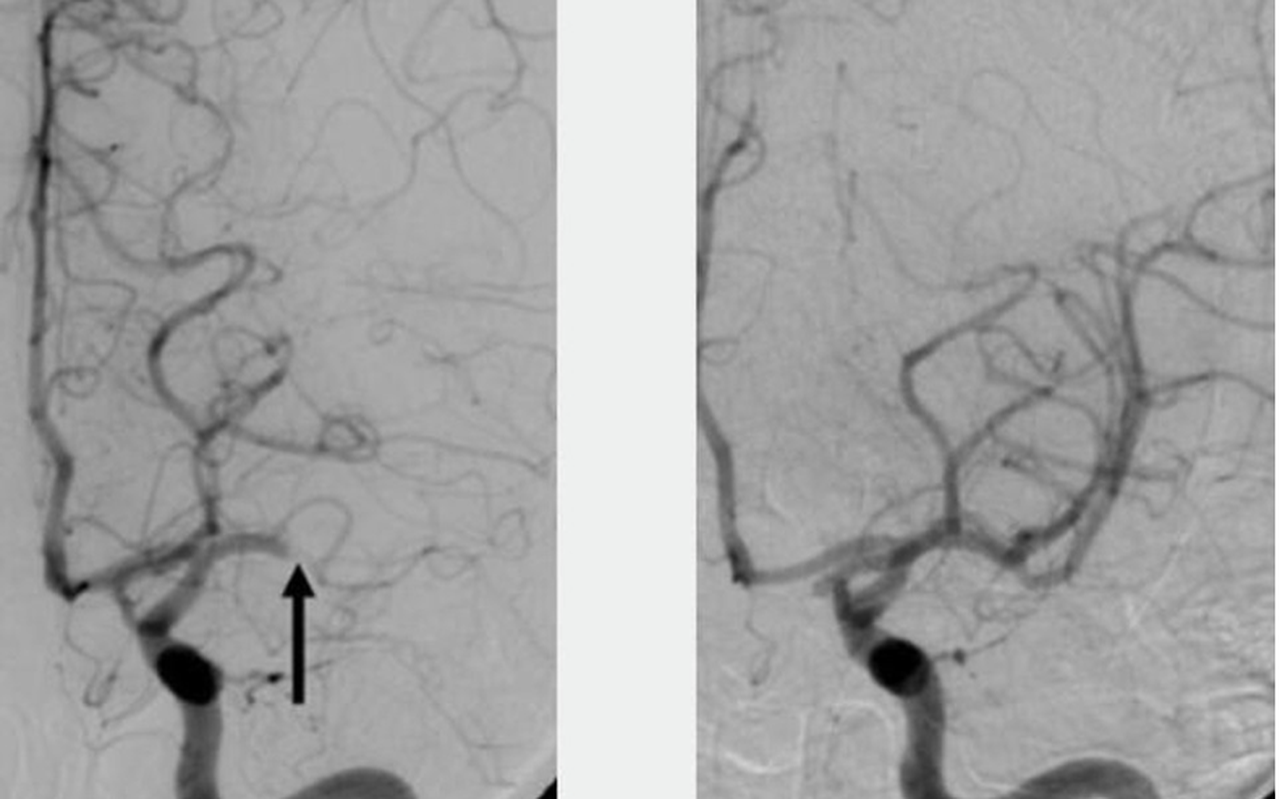 Twee afbeeldingen van bloedvaten in de hersenen: een stolsel bij pijl (links) en zichtbare hernieuwde doorstroming bloedvaten na verwijdering van het stolsel na katheterbehandeling (rechts), — © Maastricht UMC+