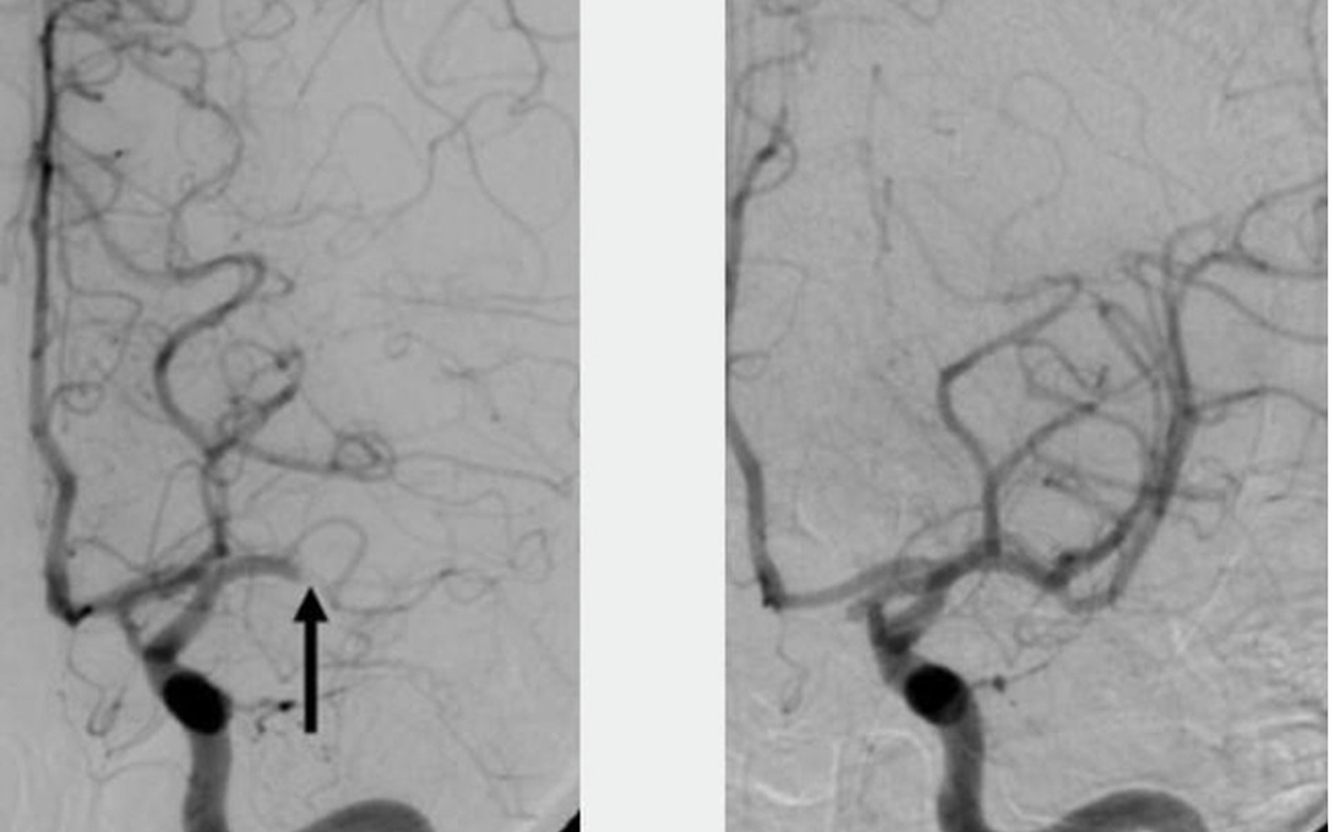 “Effective Catheter Treatment Can Improve Brain Damage in Stroke Patients Even After 24 Hours: Study Finds”